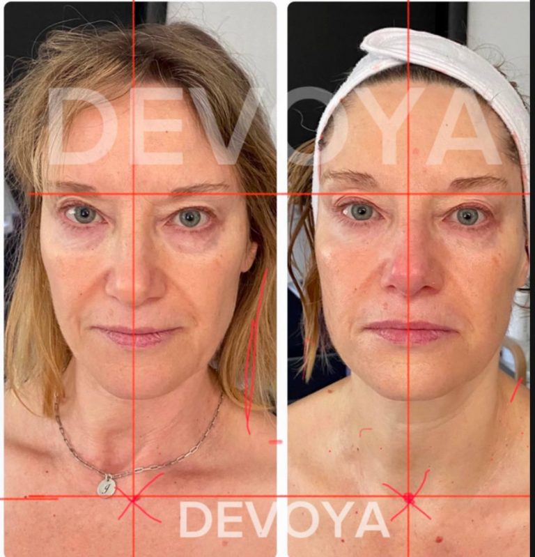 Neck Correction — Visible Transformation in One Session